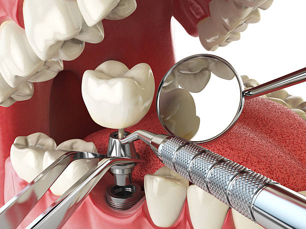 Best Knocked-Out Tooth Emergency  in Elm Creek, TX